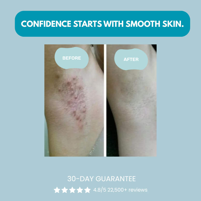 Serniwell Ingrown Hair Treatment