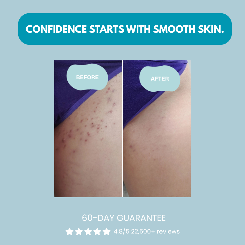 Serniwell Ingrown Hair Treatment