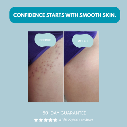Serniwell Ingrown Hair Treatment